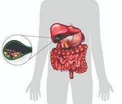 صورة توضيحية لحصوات المرارة